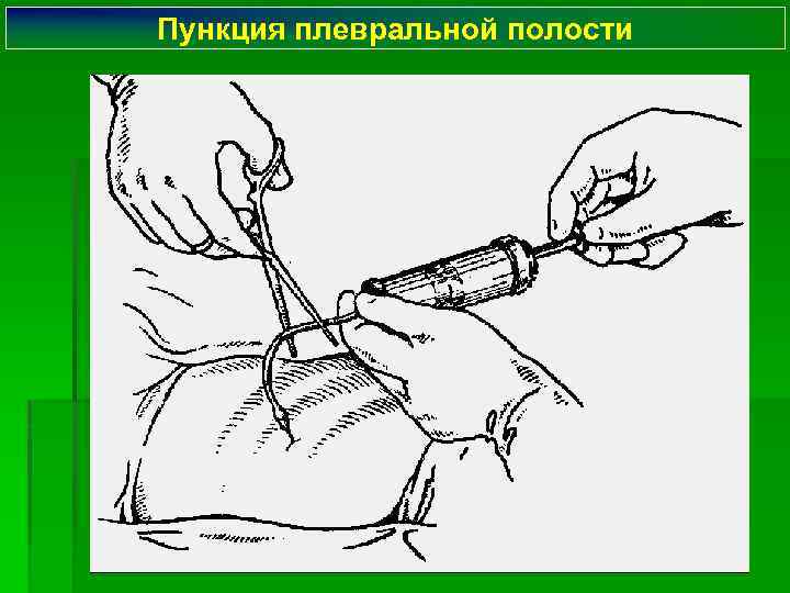 Пункция плевральной полости 