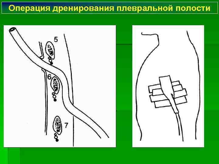 Операция дренирования плевральной полости 