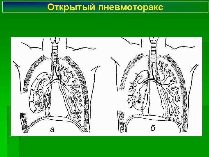Открытый пневмоторакс 