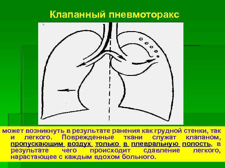Клапанный пневмоторакс может возникнуть в результате ранения как грудной стенки, так и легкого. Поврежденные
