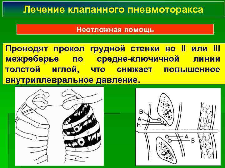 Лечение клапанного пневмоторакса Неотложная помощь Проводят прокол грудной стенки во II или III межреберье