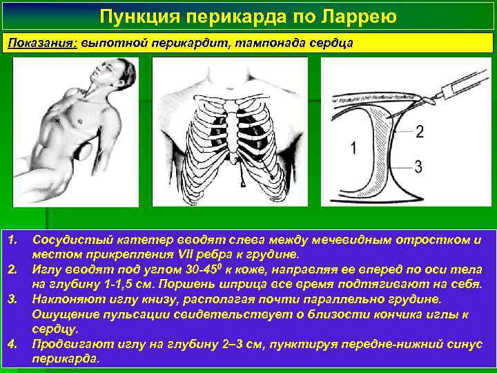 Пункция перикарда по Ларрею Показания: выпотной перикардит, тампонада сердца 1. 2. 3. 4. Сосудистый