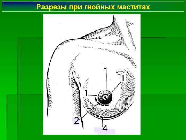 Разрезы при гнойных маститах 