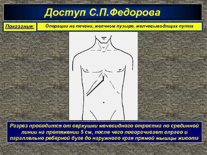 Доступ С. П. Федорова Показания: Операции на печени, желчном пузыре, желчевыводящих путях Разрез проводится