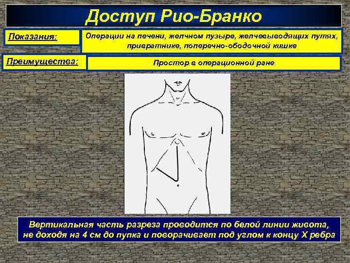 Доступ Рио-Бранко Показания: Преимущества: Операции на печени, желчном пузыре, желчевыводящих путях, привратнике, поперечно-ободочной кишке