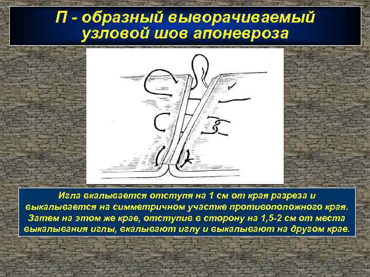 П - образный выворачиваемый узловой шов апоневроза Игла вкалывается отступя на 1 см от