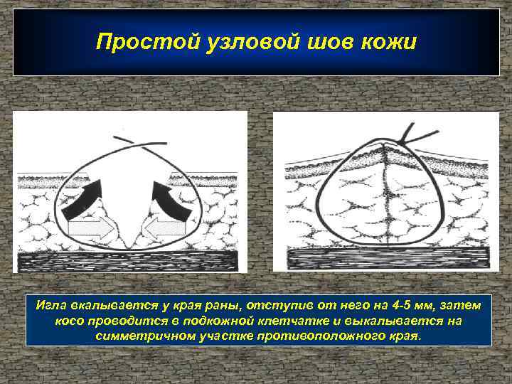 Простой узловой шов кожи Игла вкалывается у края раны, отступив от него на 4