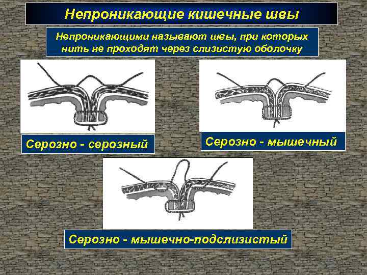 Непроникающие кишечные швы Непроникающими называют швы, при которых нить не проходят через слизистую оболочку