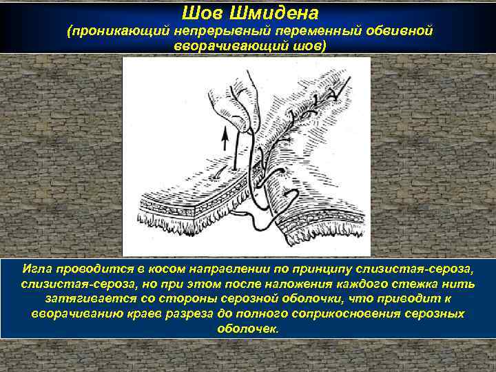 Шов Шмидена (проникающий непрерывный переменный обвивной вворачивающий шов) Игла проводится в косом направлении по