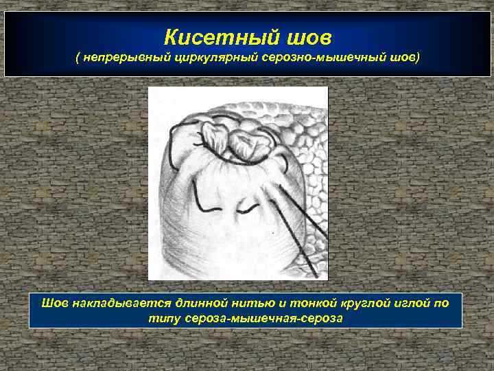 Кисетный шов ( непрерывный циркулярный серозно-мышечный шов) Шов накладывается длинной нитью и тонкой круглой