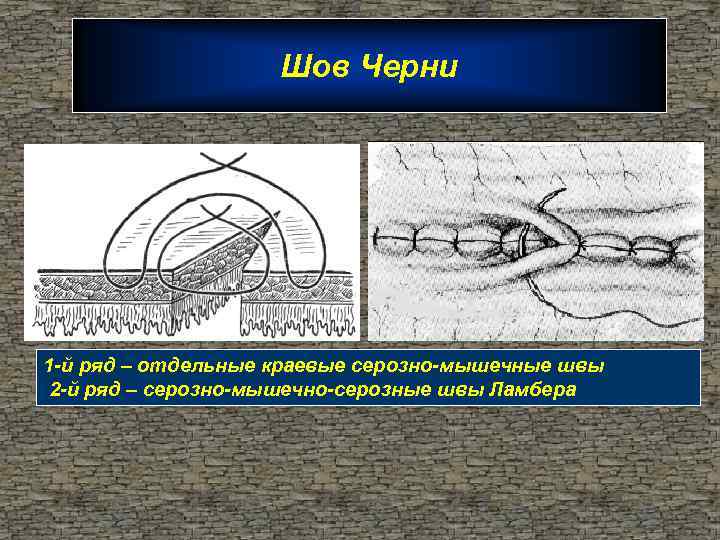 Шов Черни 1 -й ряд – отдельные краевые серозно-мышечные швы 2 -й ряд –