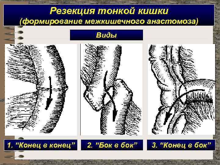 Резекция тонкой кишки (формирование межкишечного анастомоза) Виды 1. “Конец в конец” 2. “Бок в