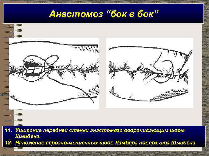Анастомоз “бок в бок” 11. Ушивание передней стенки анастомоза вворачивающим швом Шмидена. 12. Наложение