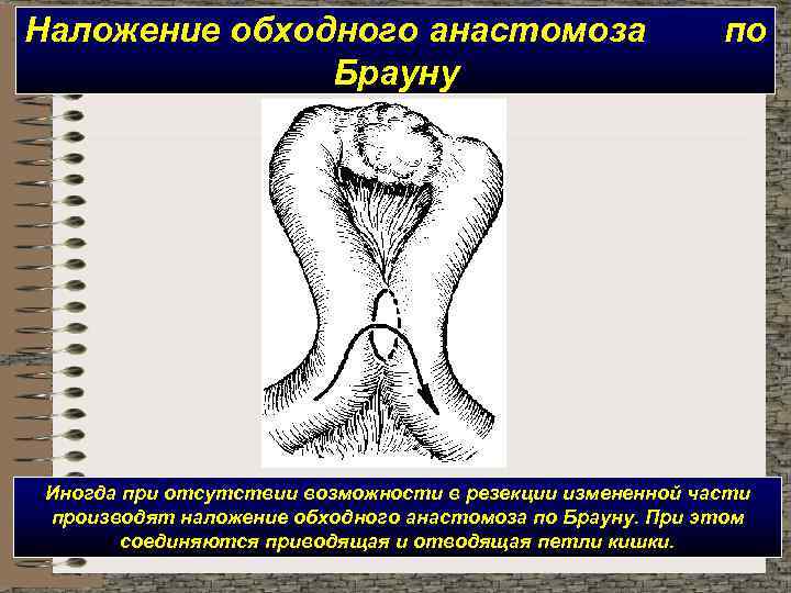 Наложение обходного анастомоза Брауну по Иногда при отсутствии возможности в резекции измененной части производят