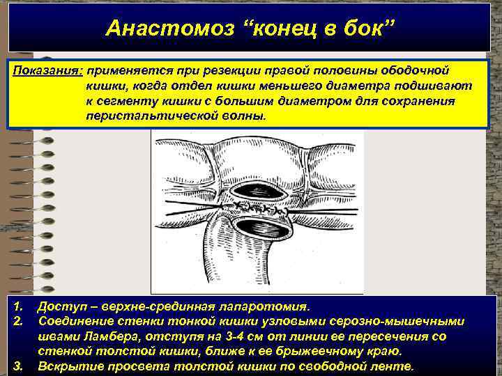 Анастомоз “конец в бок” Показания: применяется при резекции правой половины ободочной кишки, когда отдел