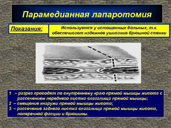 Парамедианная лапаротомия Показания: Используется у истощенных больных, т. к. обеспечивает надежное ушивание брюшной стенки