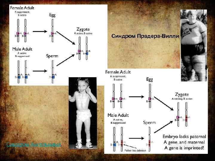 Синдром Прадера-Вилли Синдром Ангельмана. 