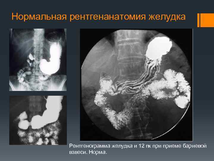 Рентгеноскопия пищевода и желудка