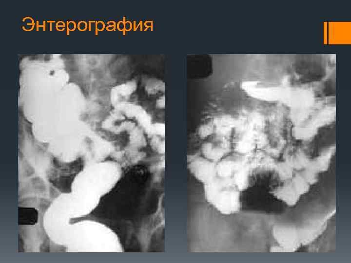 Энтерография подготовка