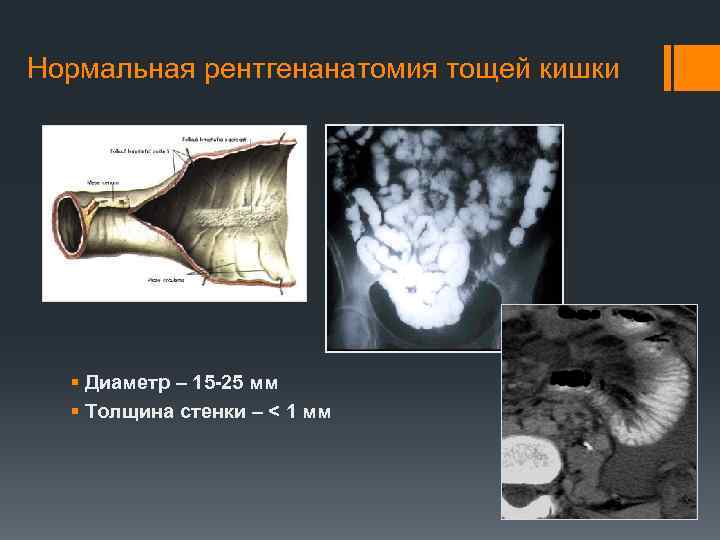 Толщина стенки тощей кишки