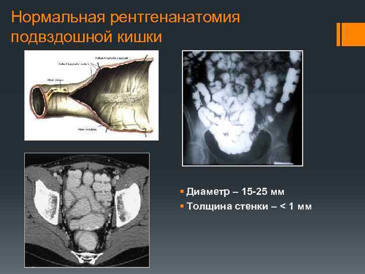 Нормальная рентгенанатомия подвздошной кишки § Диаметр – 15 -25 мм § Толщина стенки –