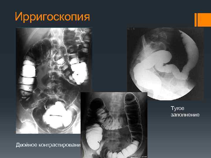 Ирригоскопия кишечника