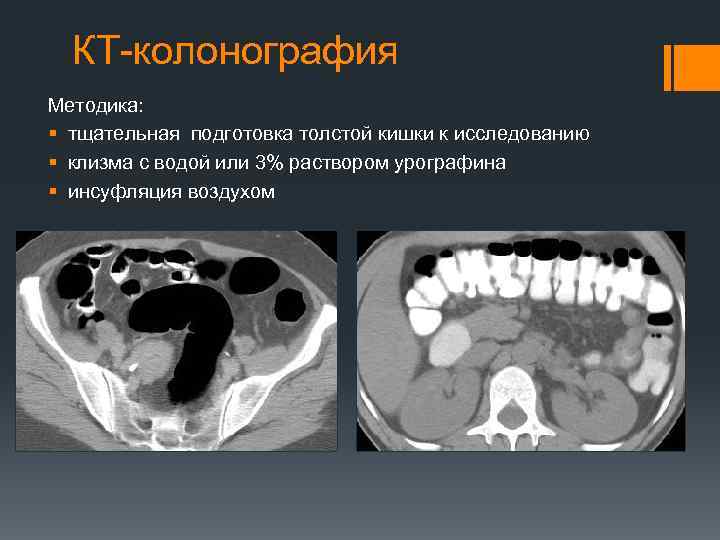 КТ-колонография Методика: § тщательная подготовка толстой кишки к исследованию § клизма с водой или