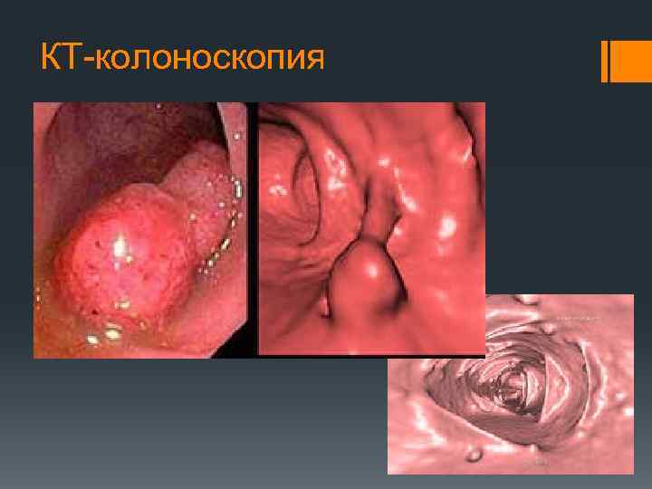 КТ-колоноскопия 