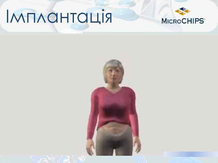 Імплантація 