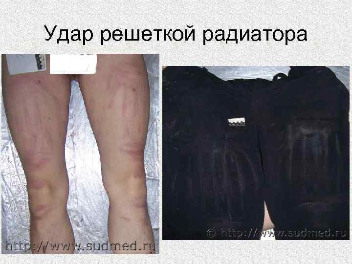 Удар решеткой радиатора 