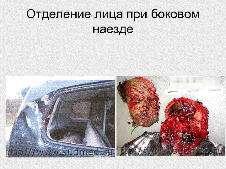 Отделение лица при боковом наезде 