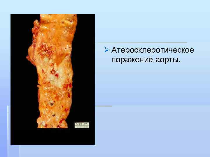 Ø Атеросклеротическое поражение аорты. 