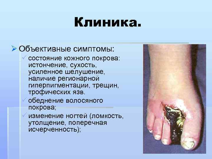 Клиника. Ø Объективные симптомы: ü состояние кожного покрова: истончение, сухость, усиленное шелушение, наличие регионарной