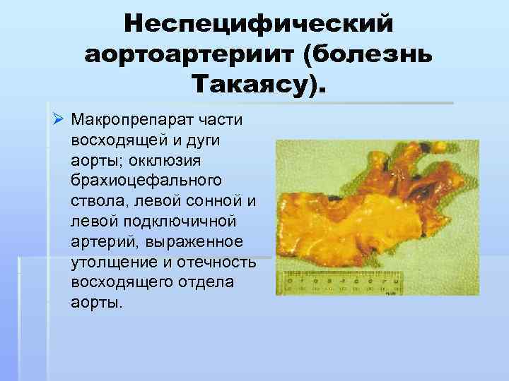 Неспецифический аортоартериит (болезнь Такаясу). Ø Макропрепарат части восходящей и дуги аорты; окклюзия брахиоцефального ствола,