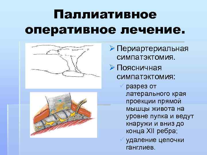 Паллиативное оперативное лечение. Ø Периартериальная симпатэктомия. Ø Поясничная симпатэктомия: ü разрез от латерального края