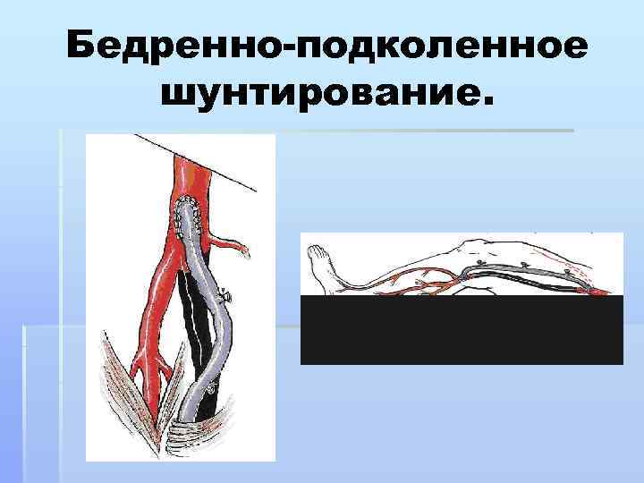 Операция на артерии нижних конечностей. Техника операции бедренно подколенного шунтирования. Проксимальное бедренно подколенное шунтирование. Шунтирование периферических артерий. Шунтирование сосудов нижних конечностей.