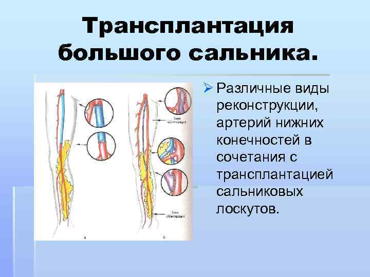 Перекрут большого сальника