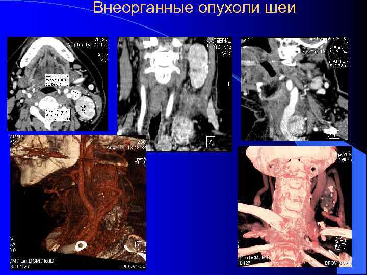 Внеорганные опухоли шеи l 