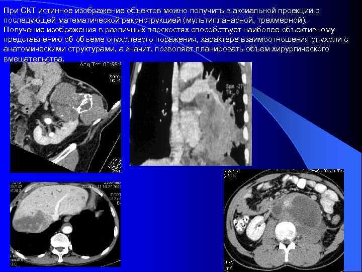 При СКТ истинное изображение объектов можно получить в аксиальной проекции с последующей математической реконструкцией
