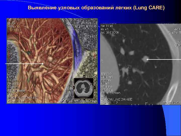 Выявление узловых образований легких (Lung CARE) 