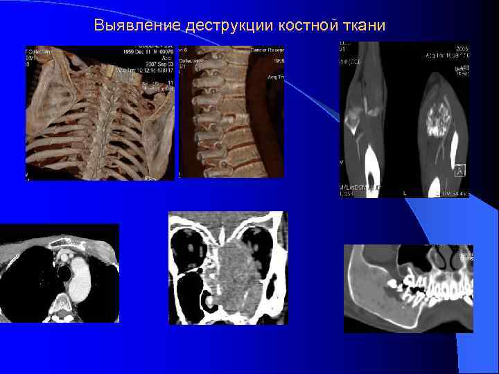 Деструкция костной ткани