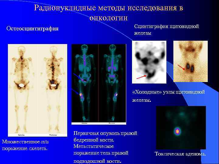 Радионуклидные методы исследования в онкологии Сцинтиграфия щитовидной железы Остеосцинтиграфия «Холодные» узлы щитовидной железы. Множественное