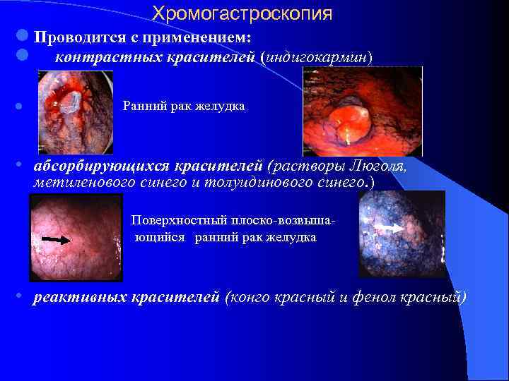 Хромогастроскопия l Проводится с применением: l контрастных красителей (индигокармин) l Ранний рак желудка •