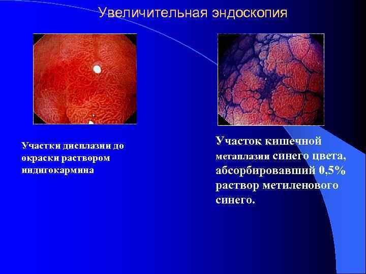 Увеличительная эндоскопия Участки дисплазии до окраски раствором индигокармина Участок кишечной метаплазии синего цвета, абсорбировавший