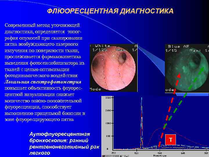 ФЛЮОРЕСЦЕНТНАЯ ДИАГНОСТИКА Современный метод уточняющей диагностики, определяется топография опухолей при сканировании пятна возбуждающего лазерного