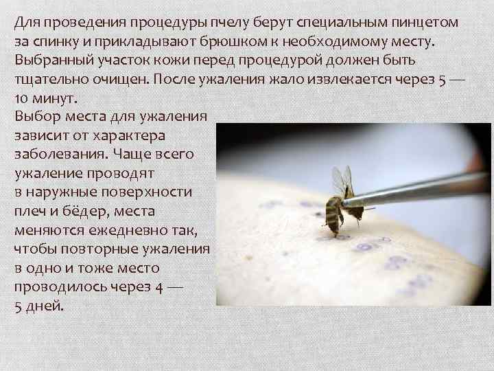 Для проведения процедуры пчелу берут специальным пинцетом за спинку и прикладывают брюшком к необходимому