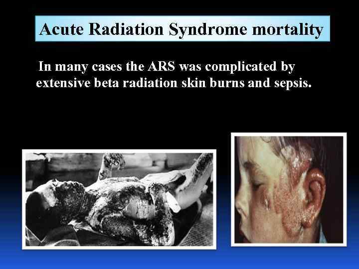 Acute Radiation Syndrome mortality In many cases the ARS was complicated by extensive beta