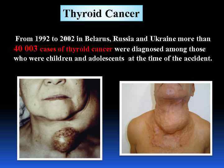 Thyroid Cancer From 1992 to 2002 in Belarus, Russia and Ukraine more than 40