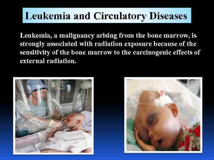 Leukemia and Circulatory Diseases Leukemia, a malignancy arising from the bone marrow, is strongly