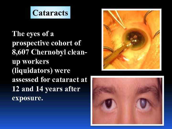 Cataracts The eyes of a prospective cohort of 8, 607 Chernobyl cleanup workers (liquidators)